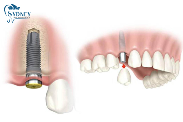 Trồng răng implant an toàn và thích hợp cho mọi đối tượng