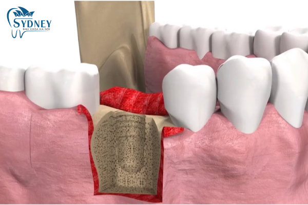 Phần trụ implant được thay thế