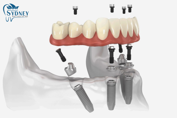 Kỹ thuật cấy ghép implant rất phức tạp