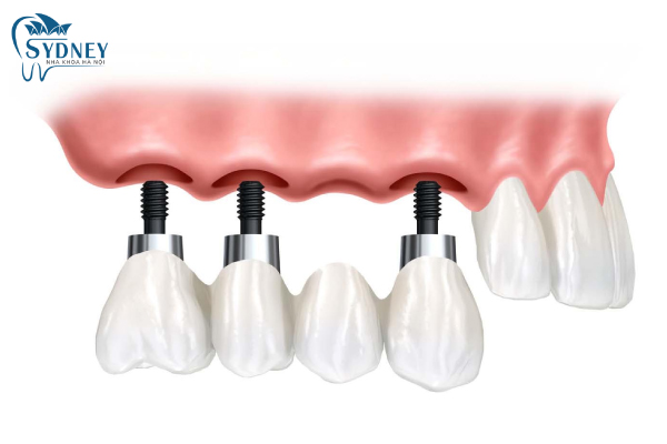 Cấy ghép implant là gì?