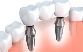 Ưu điểm của cấy ghép implant là gì