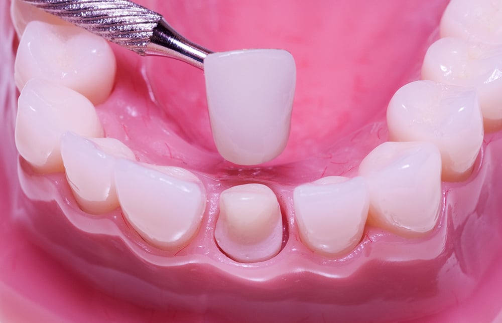 răng sứ thế hệ mới Archives  Nha Khoa Kan Dental  Thẩm mỹ nụ cười công  nghệ Mỹ