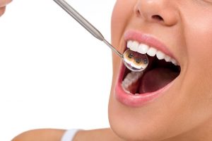 Hình ảnh niềng răng mặt trong