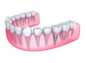 Trồng răng cấm bằng phương pháp cấy ghép implant