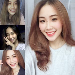 Làm thế nào giảm thiểu rủi ro khi niềng răng