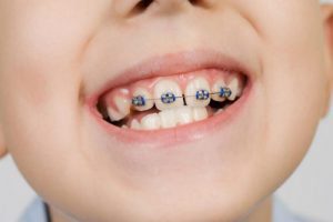 niềng răng thưa tại nha khoa sydney