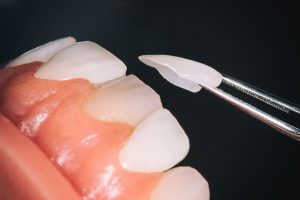 Bọc răng sứ giúp trồng răng khểnh không đau?