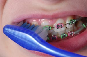 Nguy cơ tổn thương răng nếu không chăm sóc đúng cách
