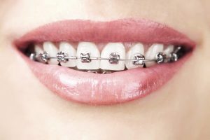Phương pháp niềng răng mắc kim loại