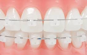 phương pháp niềng răng mắc cài pha lê hiệu quả nhất hiện nay