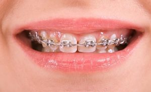 iềng răng thưa bằng phương pháp mắc cài sứ