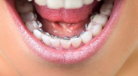 Niềng răng hàm dưới bằng phương pháp niềng mặt trong