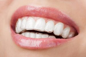 Niềng răng Invisalign là gì