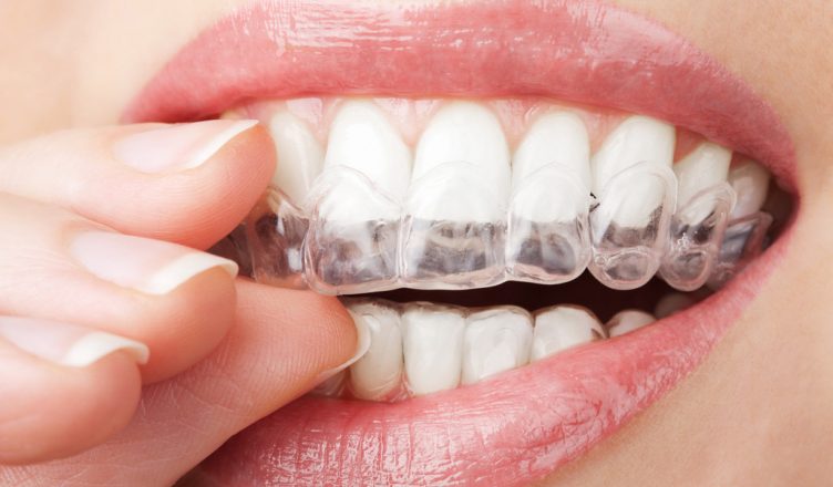 Niềng răng không mắc cài