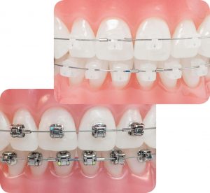 Niềng răng mắc cài pha lê có những lợi ích gì.
