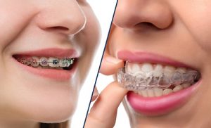 2 phương pháp niềng răng móm hiệu quả nhất hiện nay.