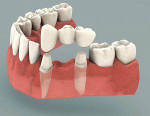 Trồng răng cấm bằng phương pháp cầu răng sứ