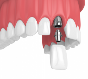 phương pháp trồng răng implant