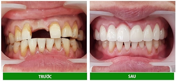 Trước và sau khi trồng răng sứ Titan
