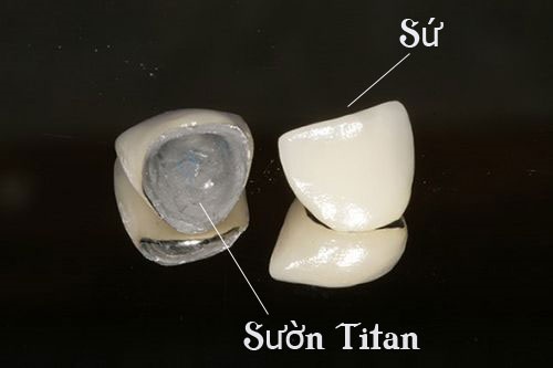 Cấu tạo của răng sứ Titan
