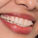Giải mã thắc mắc niềng răng có ảnh hưởng đến thần kinh không? Giải mã thắc mắc niềng răng có ảnh hưởng đến thần kinh không?