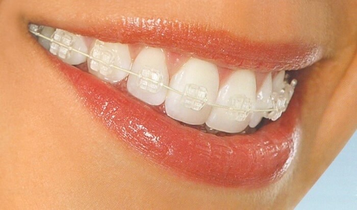 Niềng răng mắc cài sapphire
