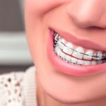 Những điều trước niềng răng khách hàng nên lưu ý Những điều trước niềng răng khách hàng nên lưu ý