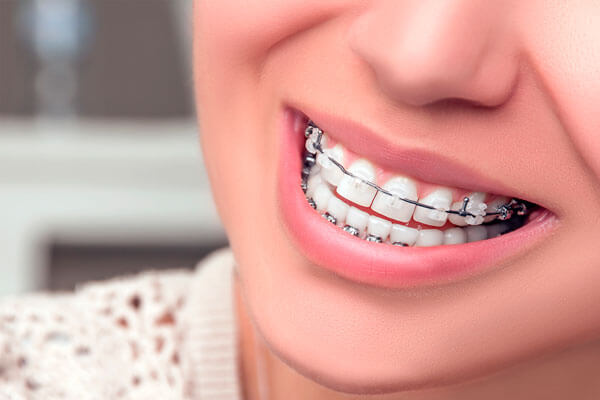 Niềng răng mắc cài sứ thường