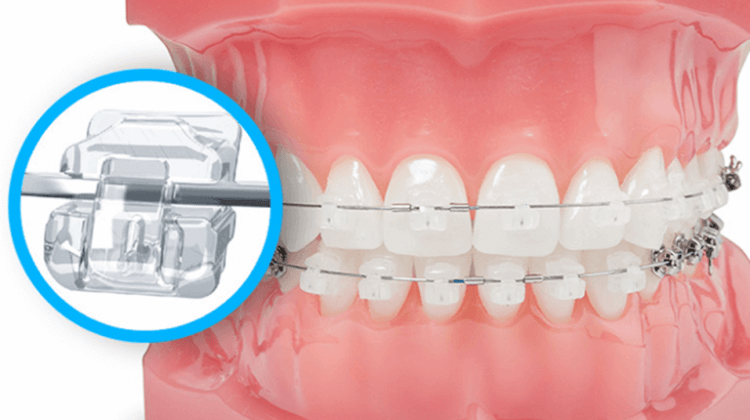 Niềng răng mắc cài sứ tự buộc