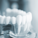 Những điều cần biết trước khi điều trị chỉnh nha – niềng răng Những điều cần biết trước khi điều trị chỉnh nha – niềng răng