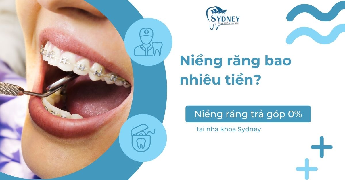 Niềng răng bao nhiêu tiền? Niềng răng trả góp 0% tại nha khoa Sydney