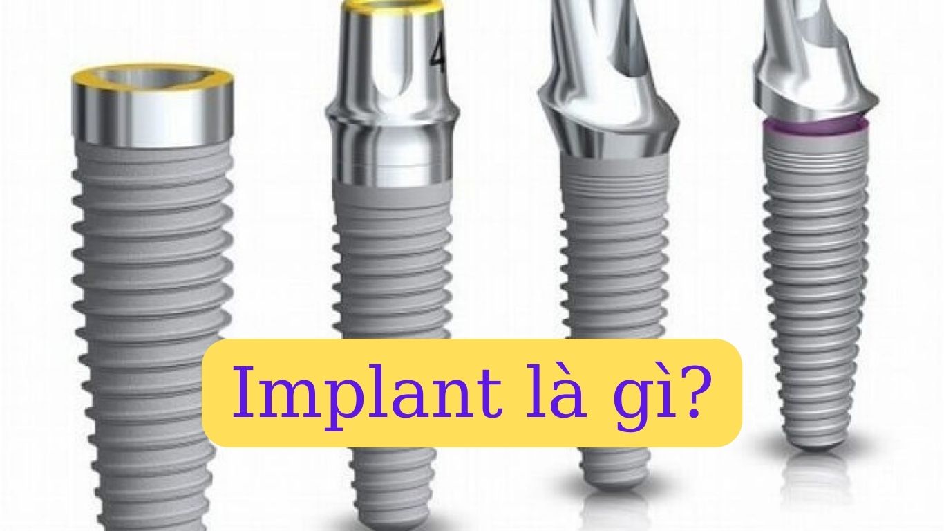 Implant là gì