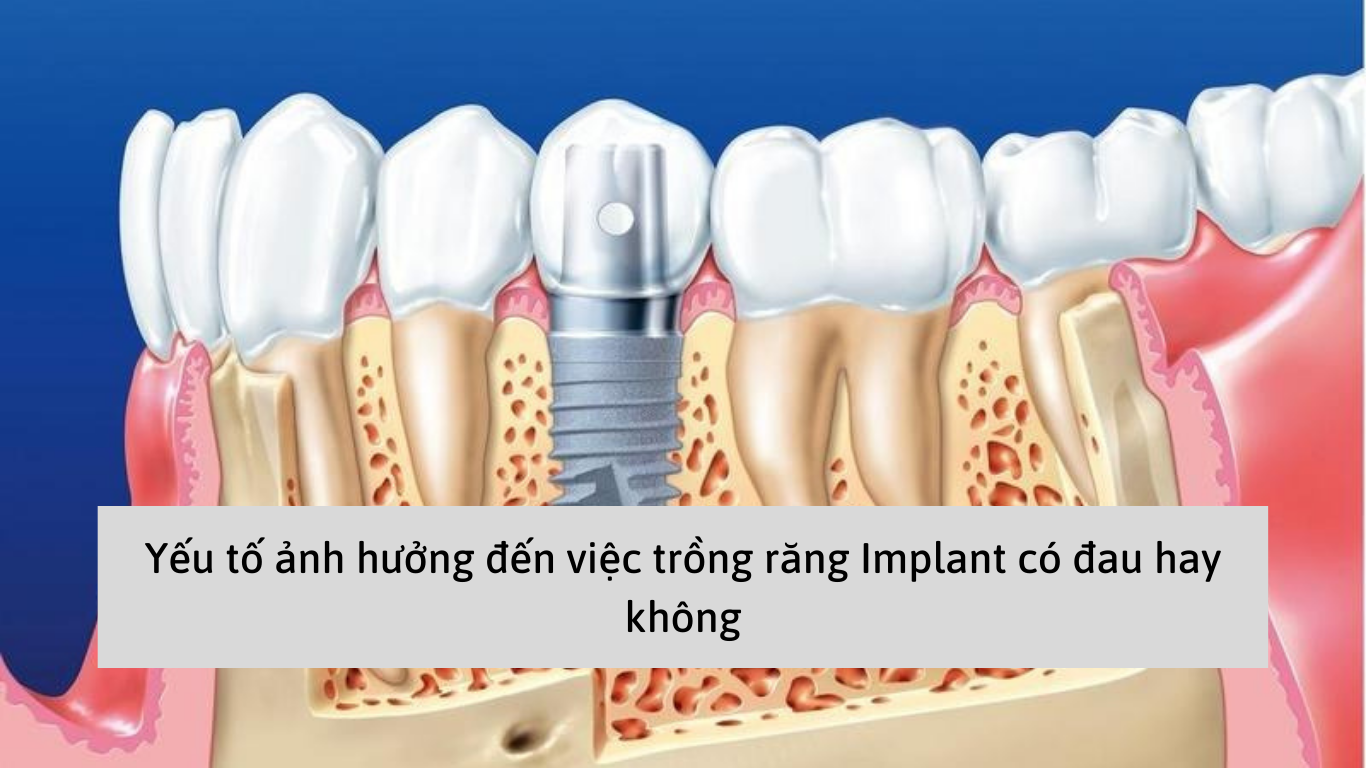 Yếu tố ảnh hưởng đến việc trồng răng Implant có đau hay không