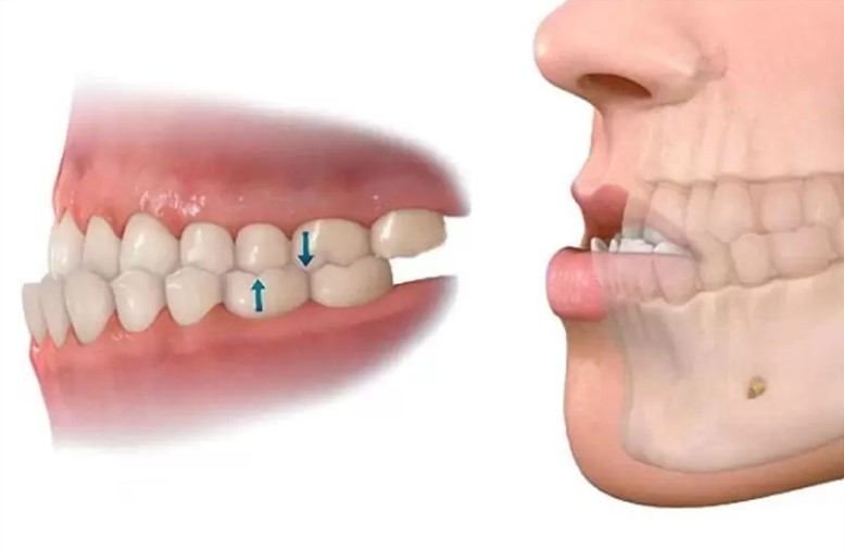 Răng hô hàm dưới
