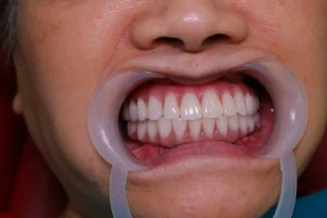 All-on-6 Dental Implants in Vietnam: Maximum-Stability Full-Arch Teeth at Hanoi Sydney Dental Clinic