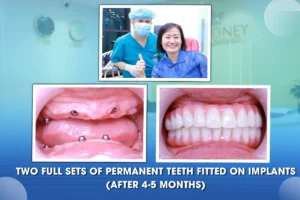 All-on-4 Dental Implants in Vietnam: Full-Arch Fixed Teeth at Hanoi Sydney Dental Clinic